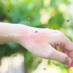 درمان خانگی نیش زنبور سریع و طبیعی