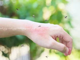 درمان خانگی نیش زنبور سریع و طبیعی