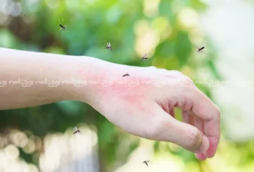 درمان خانگی نیش زنبور سریع و طبیعی