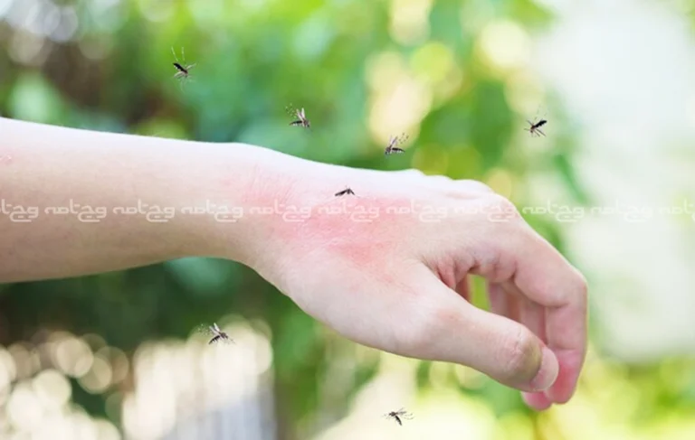 درمان خانگی نیش زنبور سریع و طبیعی